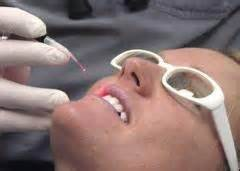 Laser Cold Sore Treatment Naples