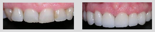 example of dental work by Dr. Ayan